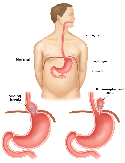 HiatalherniaPIedt2